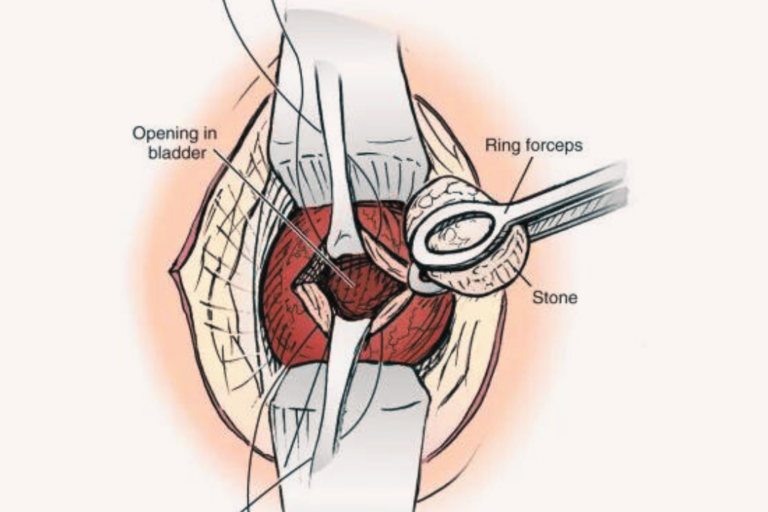 Cystolithotomy