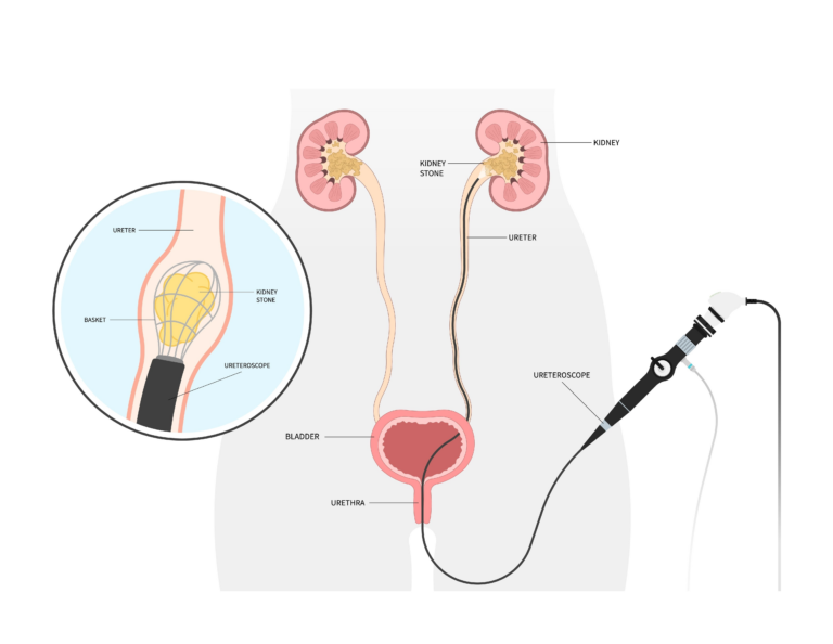 DJ Stent Removal