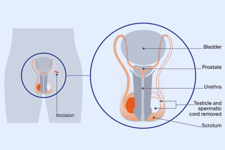 Orchidectomy